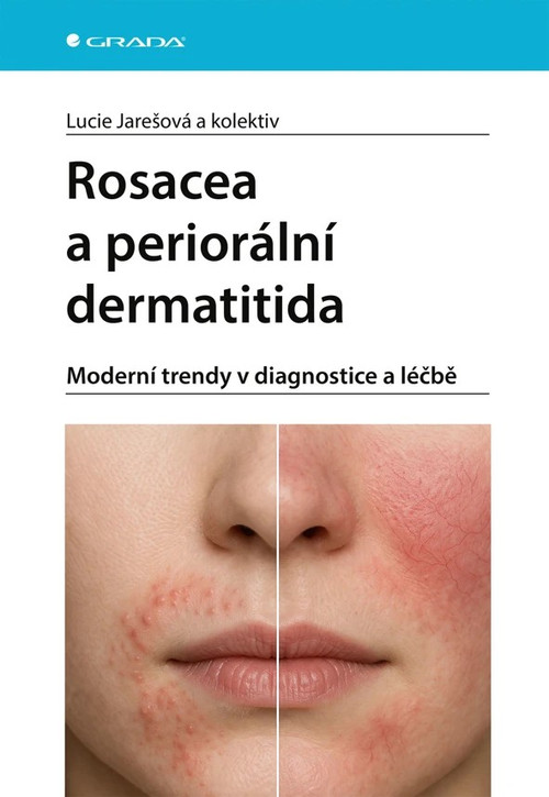 Rosacea a periorální dermatitida