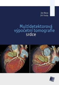 Multidetektorová výpočetní tomografie srdce