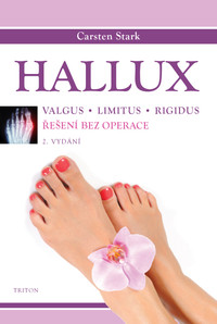 Hallux. Řešení bez operace