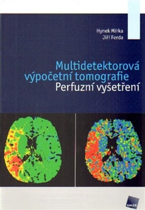 Multidetektorová výpočetní tomografie. Perfuzní vyšetření