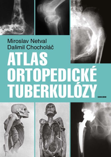 Atlas ortopedické tuberkulózy