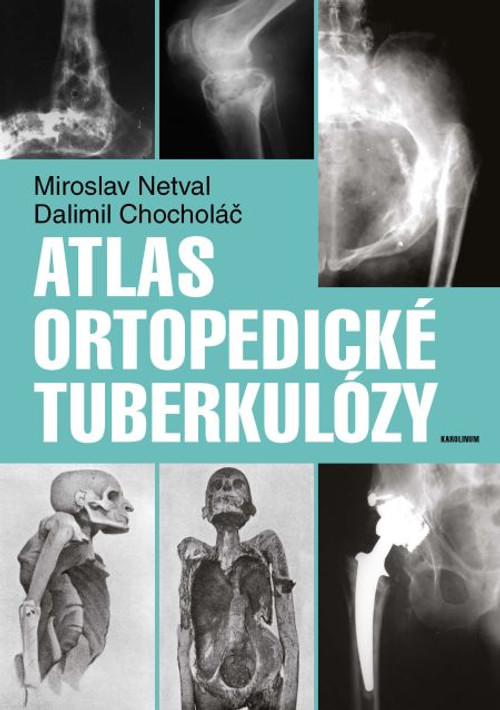 Atlas ortopedické tuberkulózy
